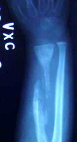 Röntgenbild des seit zwei Monaten gebrochenen und völlig vereiterten Unterarmknochens.