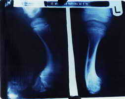 Röntgenbild des linken Beines.