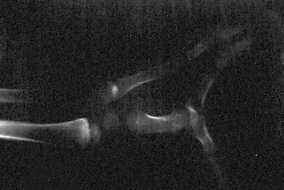 Röntgenbild der linken Hand.