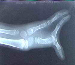 Neueste Röntgenaufnahme von Kadeks linker Hand.