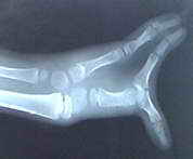 X-ray of Kadek's hand before surgery