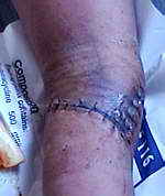 the wound on Kumar's leg